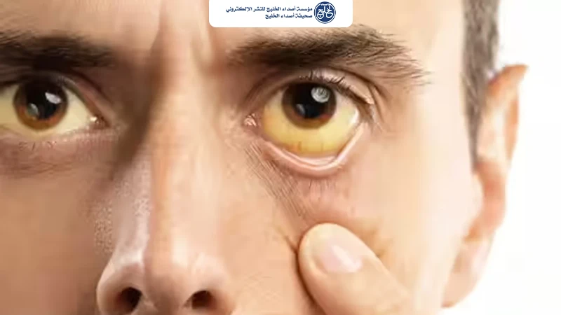 البقع حول العينين مؤشر مبكر لأمراض القلب والسكتة الدماغية